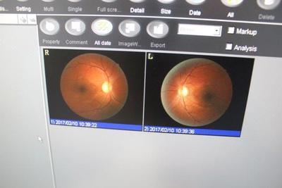 Non-mydriatic fundus camera 2