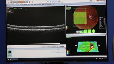 Optical Coherence Tomography 3
