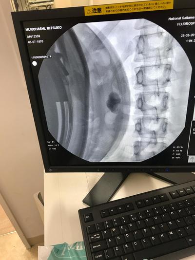 Lithotripsy 4