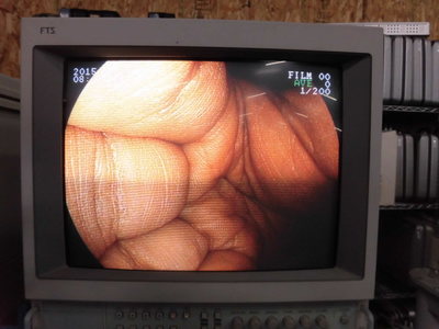 Upper gastrointestinal videoscope 5