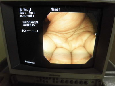 Colon videoscope 5