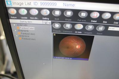 Non-mydriatic fundus camera 5