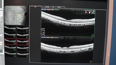 Optical Coherence Tomography 5