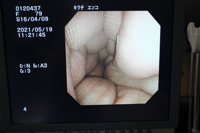 Video scope for nasal 6