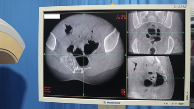O-Arm Operation Imaging System 6
